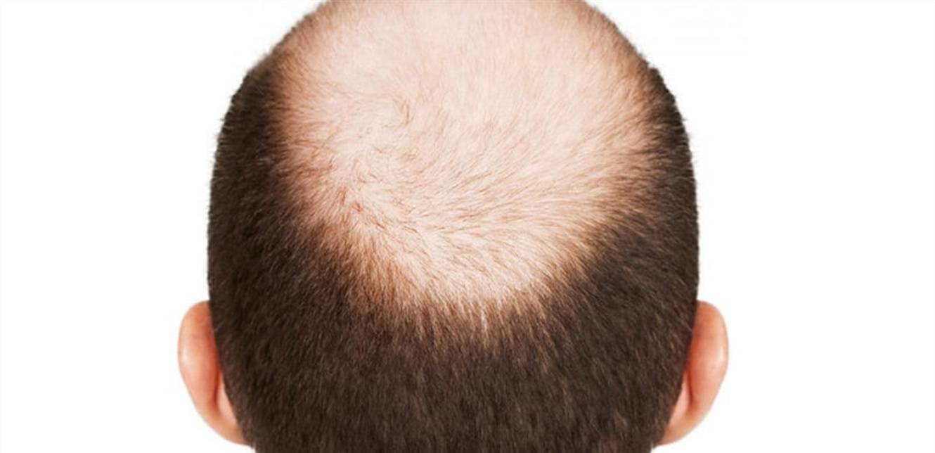 بعض المشروبات قد تؤدي الى الصلع... ما هي؟
