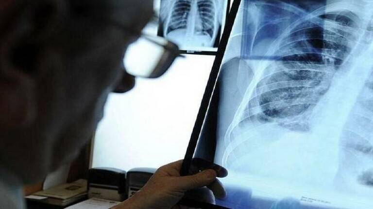 علماء: بروتين مانع لفيروس كورونا موجود في رئتي الإنسان