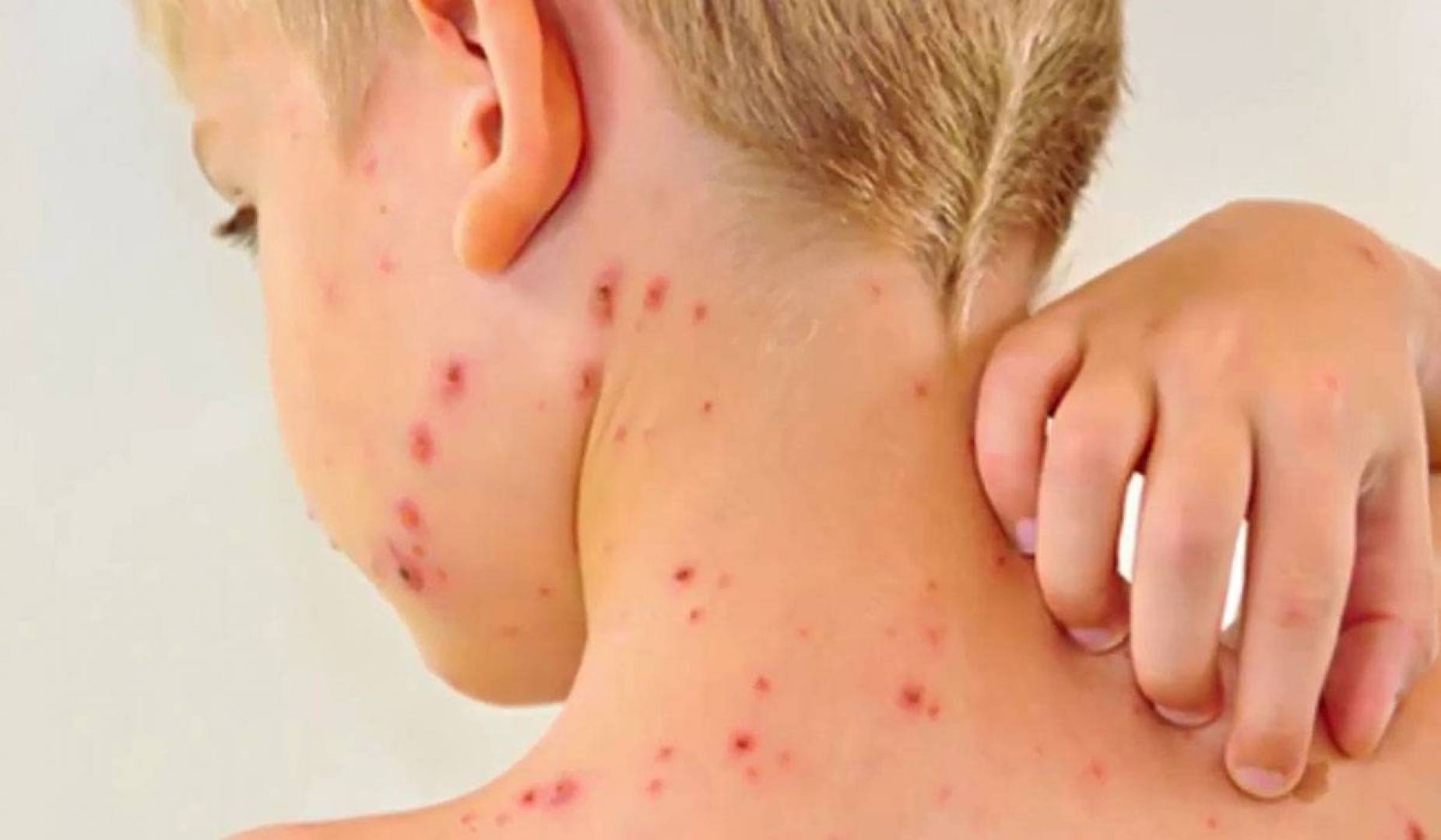 الحصبة مرض شائع ذو عواقب وخيمة... ماذا عن الأطفال؟