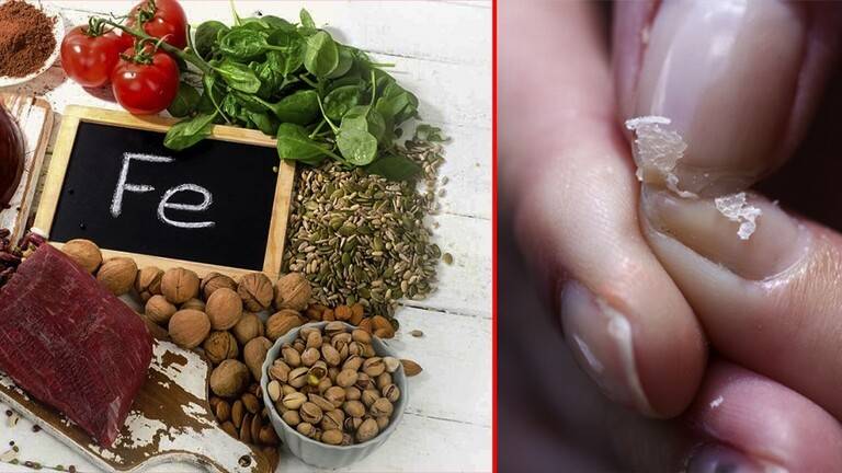 طبيبة للغدد الصماء تتحدث عن علامات نقص الحديد في جسم الإنسان