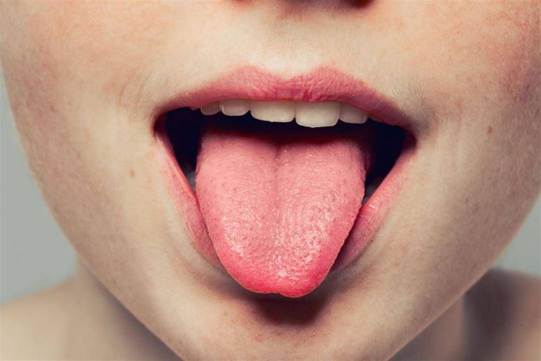 أعراض تظهر على اللسان تشير الى مُشكلة صحيّة!