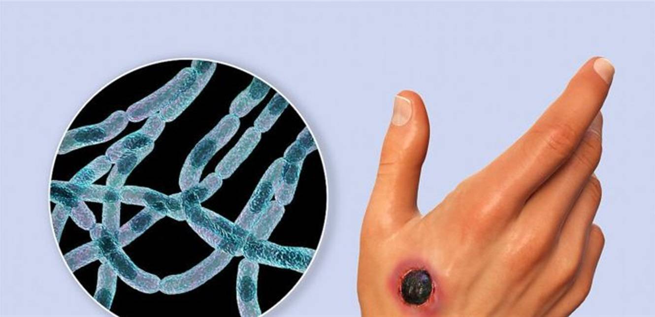 3 وفيات وأكثر من 80 اصابة.. ما هو مرض الجمرة الخبيثة الذي يفتك بهذه الدولة؟