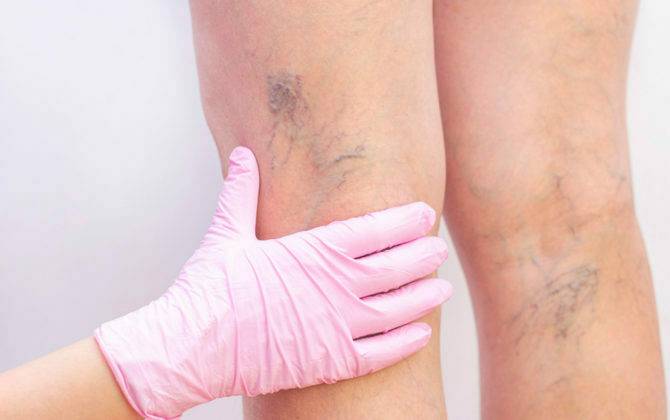 لماذا تكون النساء أكثر عرضة للإصابة بالدوالي من الرجال؟