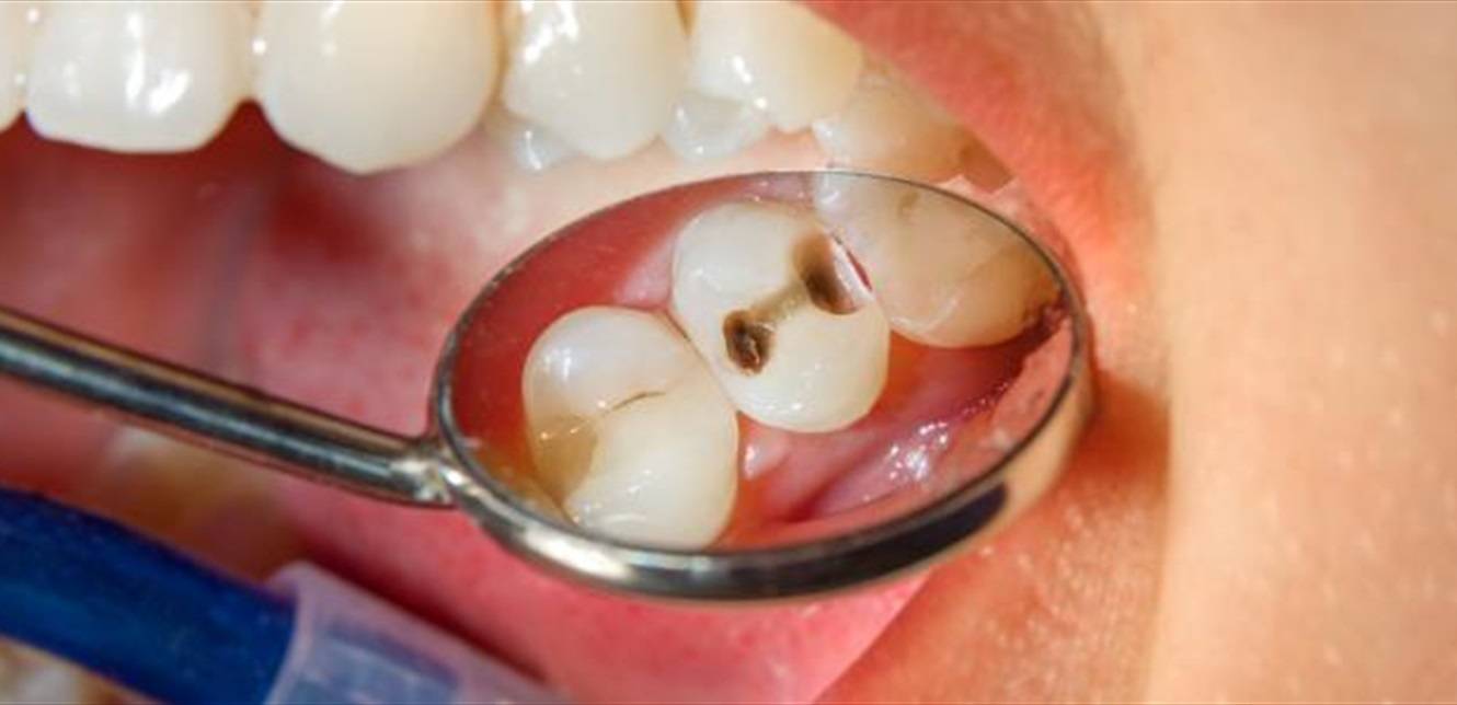 طبيب أسنان يبدد الأسطورة الشائعة حول فوائد الصودا الحلوة