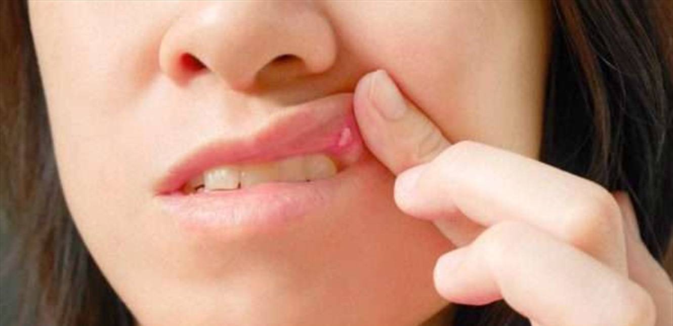 علاج التهاب الفم باستخدام الأدوية