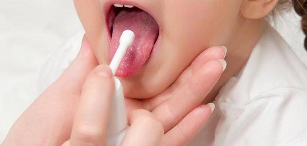 إلتهاب اللوزتين مرض شائع... متى يلجأ الطبيب لاستئصالهما؟