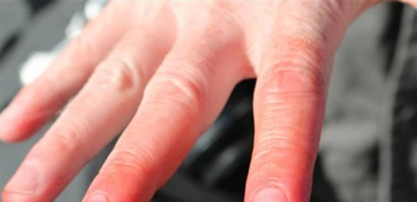 ما هو تثليج الأطراف؟ إليكم أعراضه وأسبابه وعلاجه