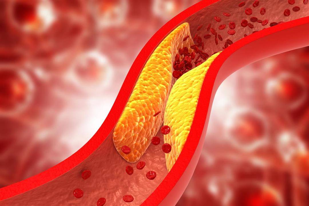 علاج جديد للكوليسترول يقلّل من خطر الإصابة بأمراض القلب