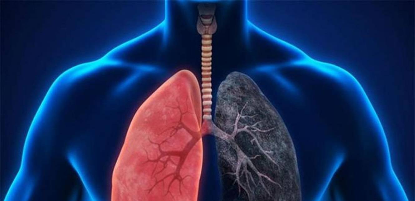 أمل جديد لعلاج مرض الانسداد الرئوي المزمن