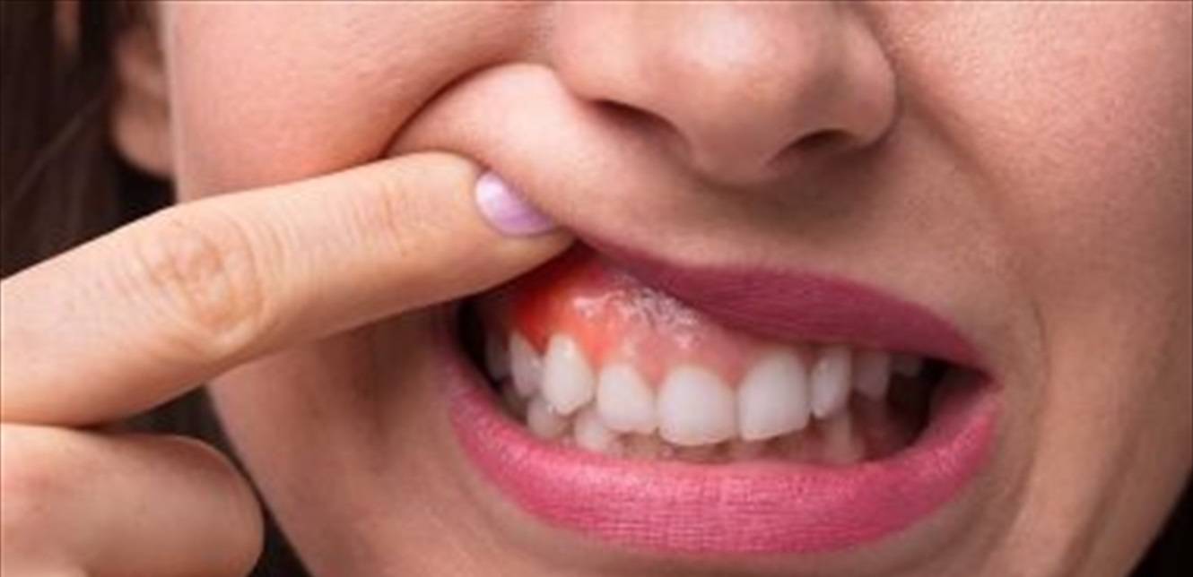 أعراض مؤلمة في فمك تشير إلى الإصابة بالأنفلونزا