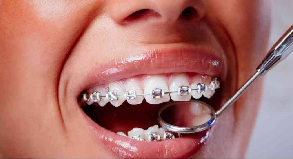 مادة ذكية لصنع أجهزة تقويم الأسنان