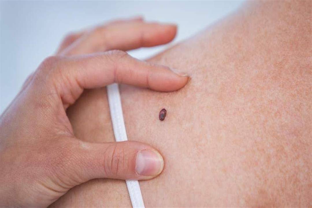 علاقة الشامات بالسرطان: علامات تدل على الخطر!