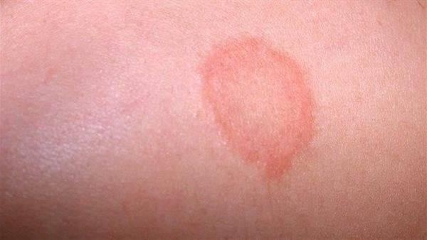 سرطان الجلد عدوٌ خفيّ... كيف تتغلّب عليه وتحمي نفسكَ؟