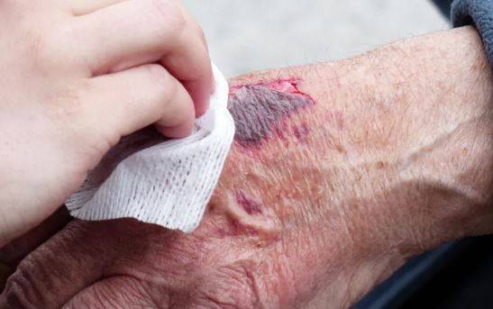 العسل... بديل طبيعي للمضادات الحيويّة في علاج الجروح؟