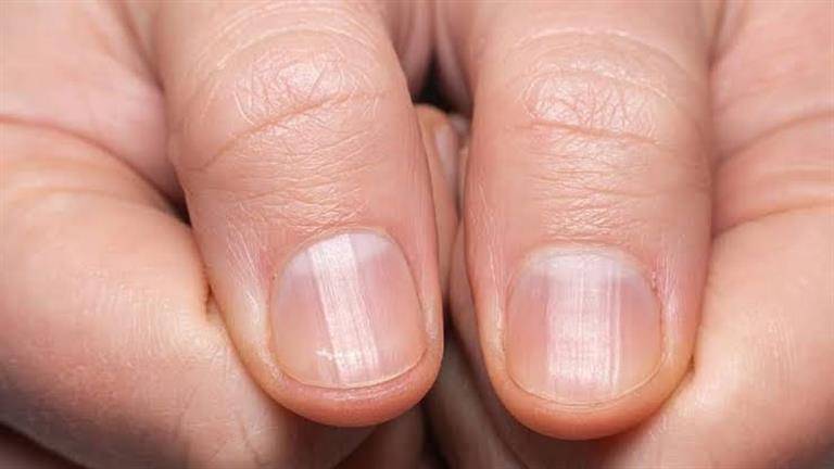 علامات تحذيريّة على أظافركَ... ماذا تعني؟