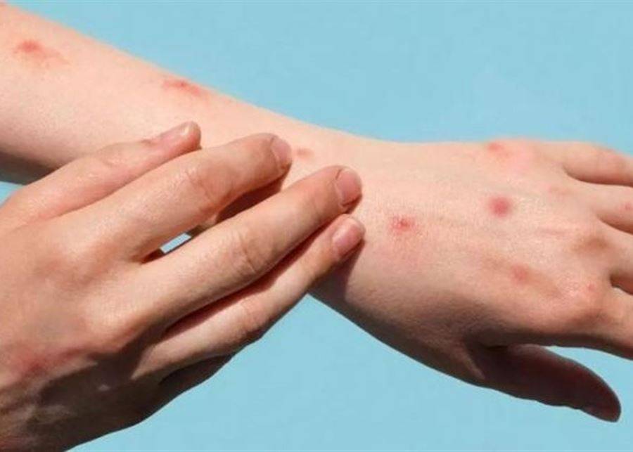 ولاية أوسترالية أعلنت ارتفاع إصابات جدري القردة وحذرت من تفشيه في أفريقيا