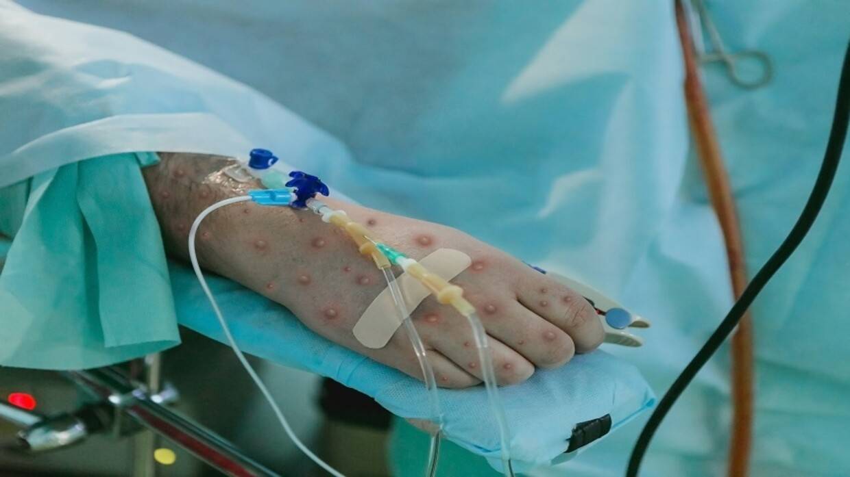 ما حقيقة انتشار جدري القرود في العراق؟