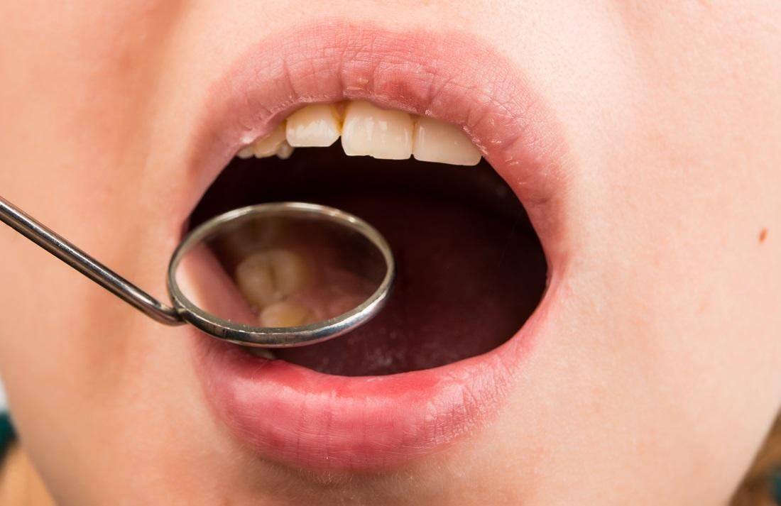 حرقان اللسان... أسبابه المتعدّدة وكيفيّة التخلّص منه