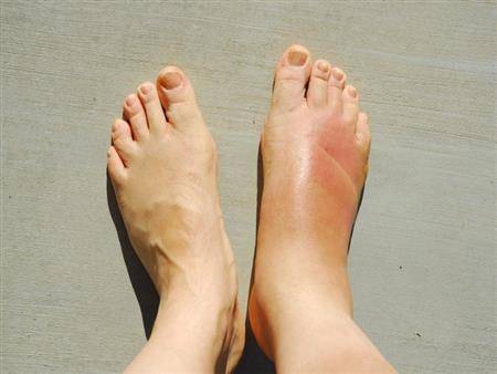 انتفاخ الساقين  في الصيف: أسبابه وكيفيّة التخلّص منه!