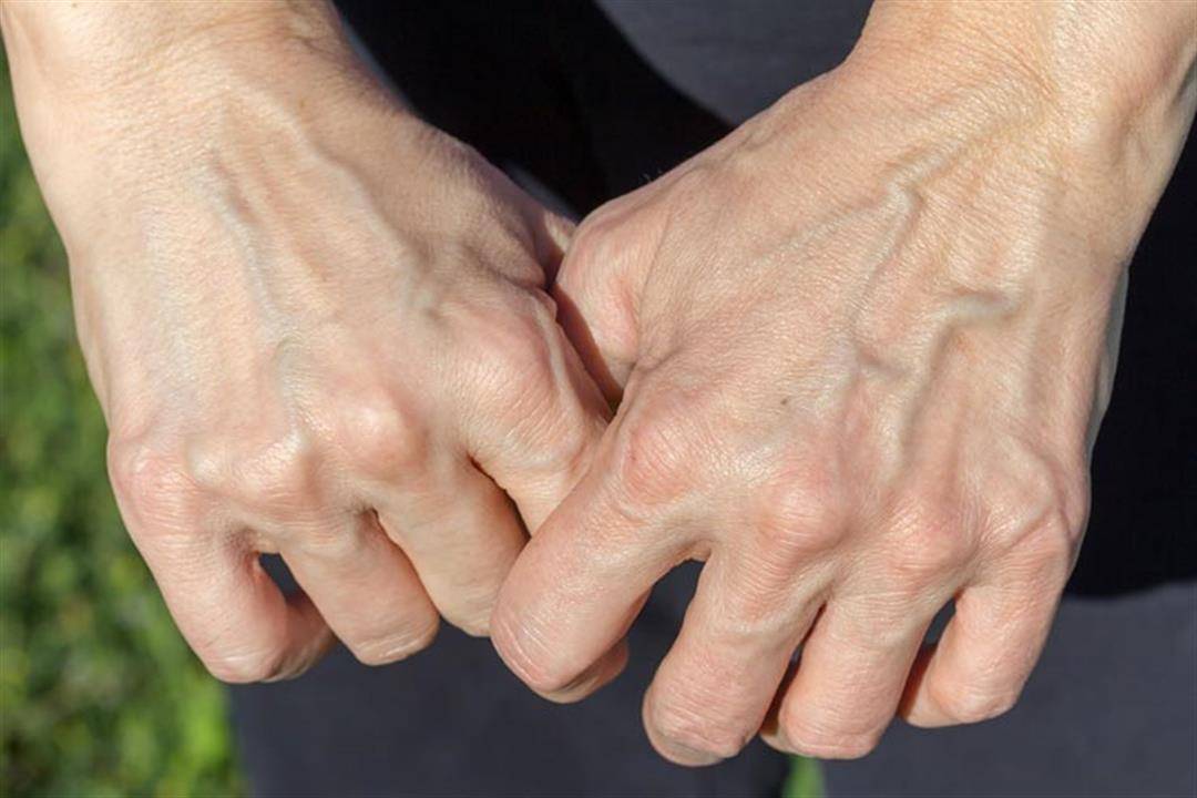 ما سبب بروز العروق في اليدين؟... تعرفوا على السر
