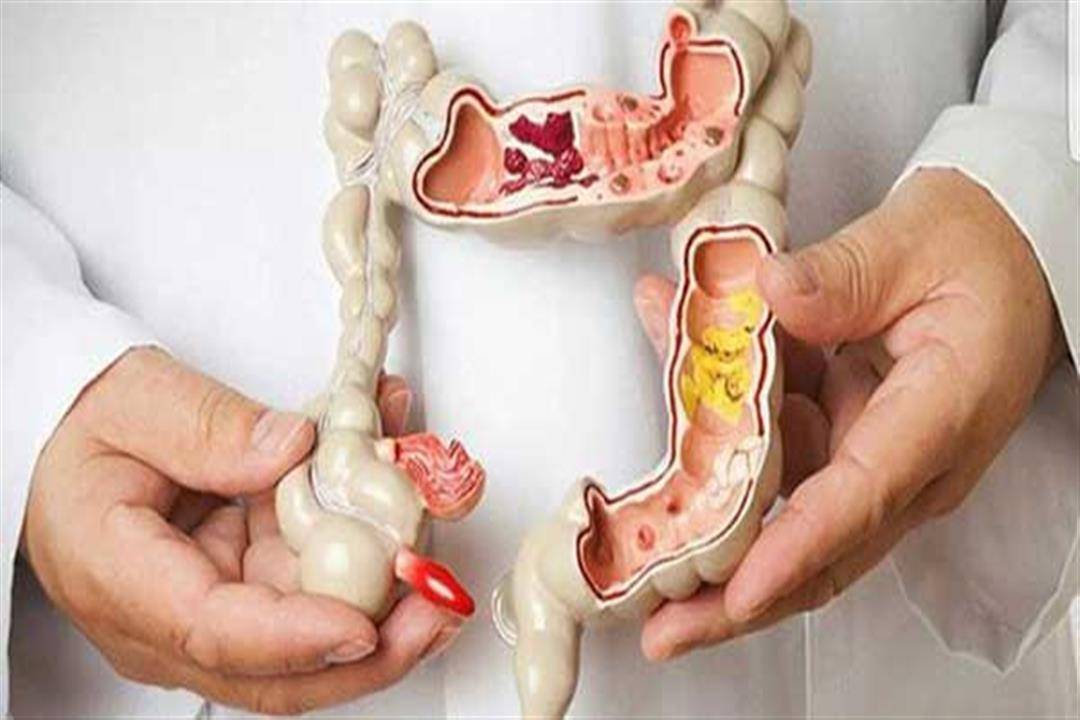 تفعلها يومياً... 7 عادات خاطئة قد تصيبك بسرطان القولون