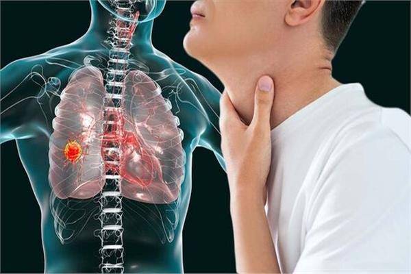 التغيّرات في الصوت... مؤشر مُبكر على الإصابة بسرطان الرئة!