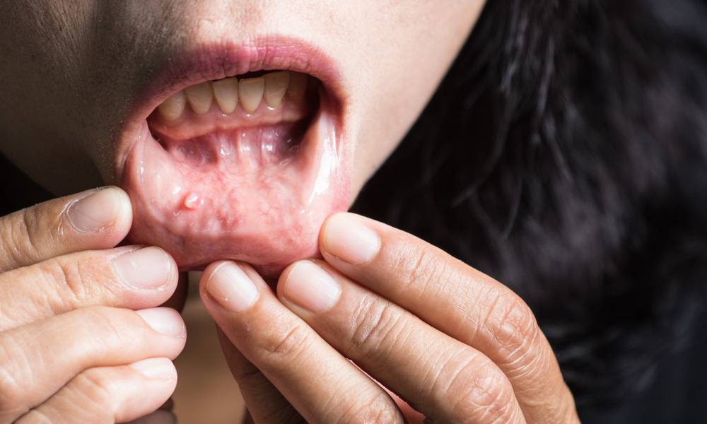 العوامل المسبّبة لسرطان الفم: ما الذي يجب تجنّبه؟