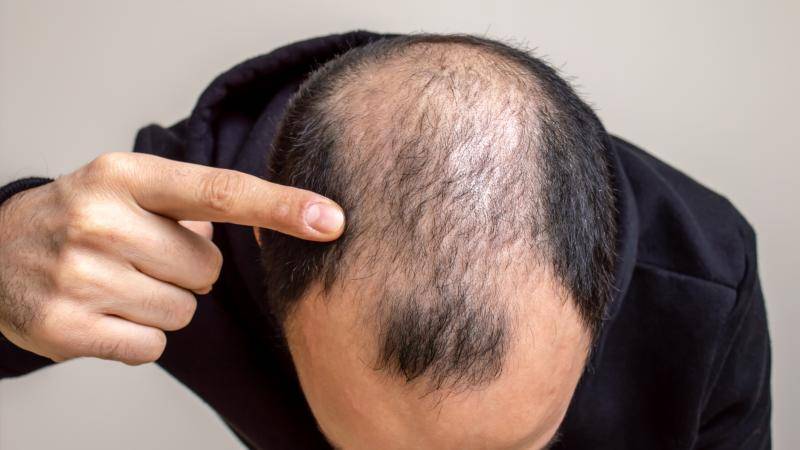 تساقط الشعر المرضي... لماذا يحدث ومن هم الأكثر تأثراً به؟
