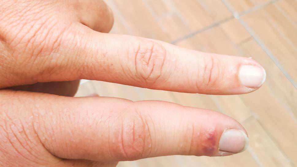 إنتفاخ الأصابع... عارض بسيط أم مُؤشر على مرض خطير؟