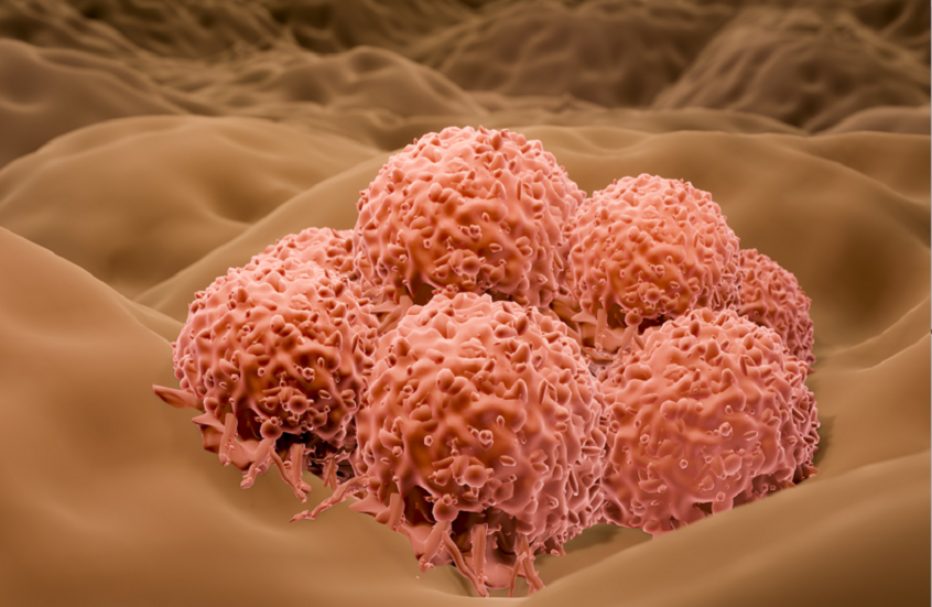 رقعة ذكية جديدة تكشف سرطان الجلد بدون تدخل جراحي!