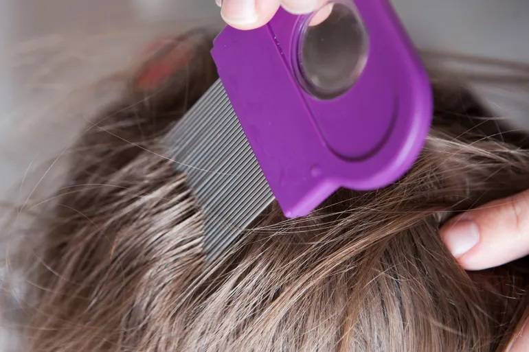 العلامات التي تكشف الإصابة بفطريات فروة الرأس