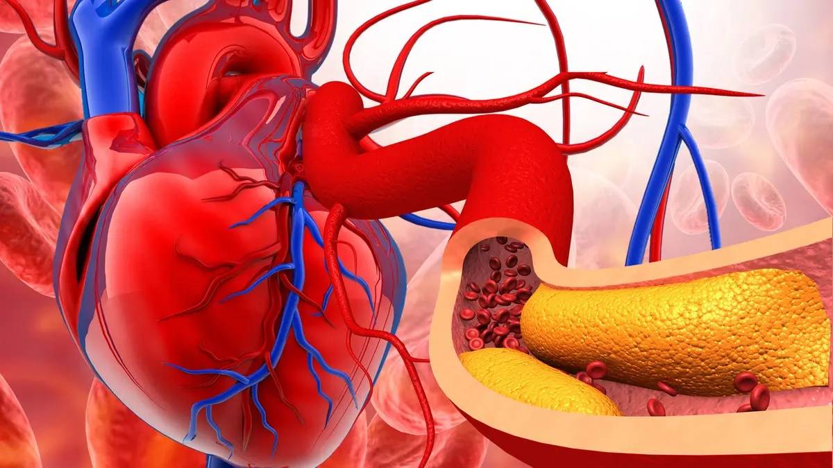 كيف يحمي التشخيص المبكر من تصلب الشرايين؟