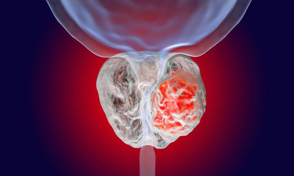 المكملات النباتية مع البكتريا النافعة قد تساهم في إبطاء سرطان البروستاتا