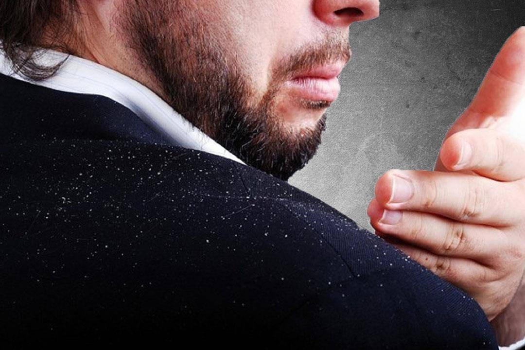 4 أسباب خفية وراء قشرة الرأس المستمرة