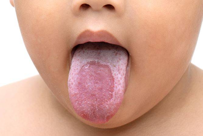 ألوان اللسان: دليل لعلامات الصحة والمرض