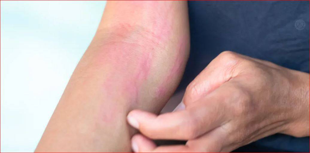 الحساسية.. مرض مزمن وأساليب علاج حديثة