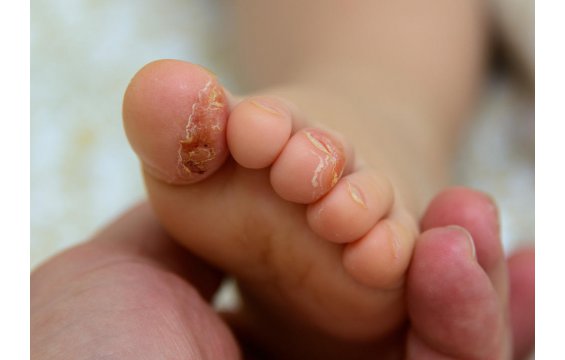 كيف تتفادى الأكزيما، وكيف تعالجه ؟