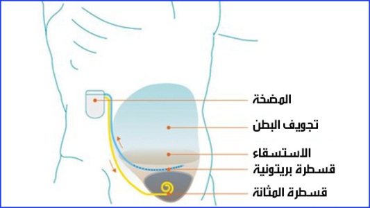 مضخة بالبطن يمكن شحنها لسحب سوائل التليف الكبدي!


