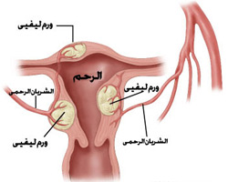 طرق لحمايتك من سرطان الرحم 