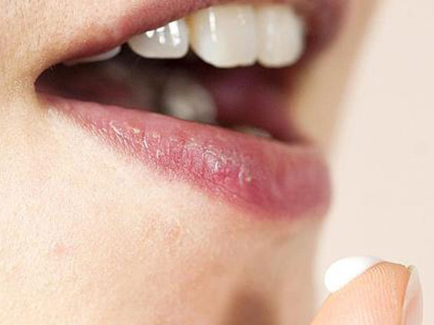 احذر لمس بثور الهربس