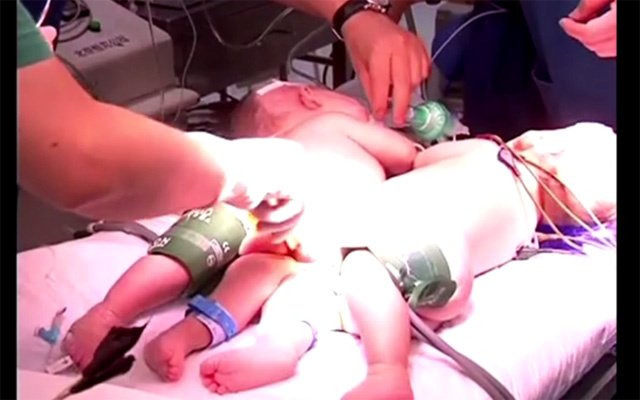 بالفيديو – فصل توأمان عن بعضهما البعض