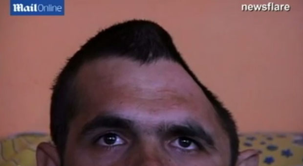 بالفيديو – فقد نصف رأسه وبقي على قيد الحياة!