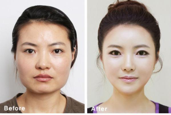 صور صادمة للكوريات بعد التجميل.. والحكومة تطلب إثبات هوية