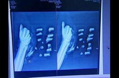 بالفيديو.. أطباء يعيدون تجميع يد مقطعة إلى 13 جزءا!