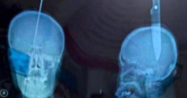 إخترق السكين رأسها باكمله وبقيت مستيقظة!.. بالصورة
