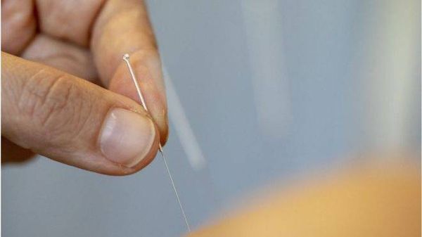 الإبر الصينية تحظى بشعبية واسعة في الكونغو