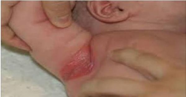 مهم جداً.. 5 نصائح لحماية طفلك من الإصابة بالتسلخات المؤلمة!