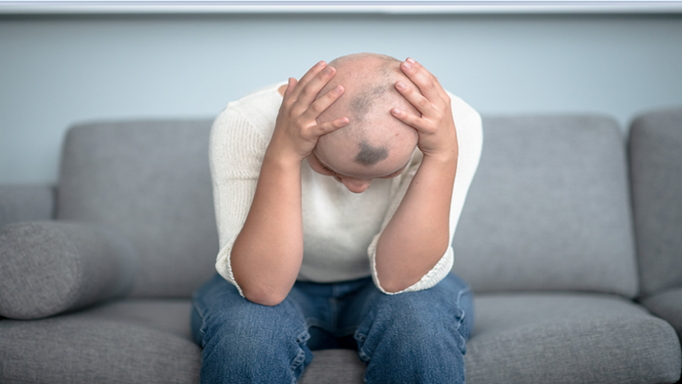 دواء شائع لالتهاب المفاصل يقدم أملا جديدا لعلاج الثعلبة الشديدة!