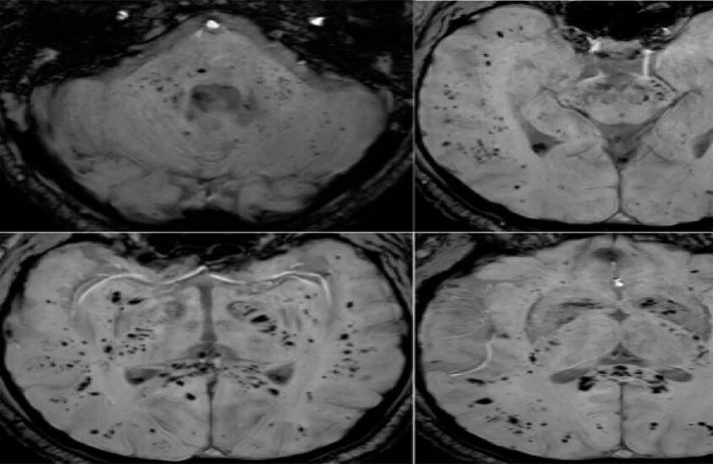 الرنين المغناطيسي يكشف تأثير كوفيد-19 على الدماغ