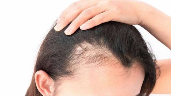 6 بدائل طبيعية لمحاربة تساقط الشعر